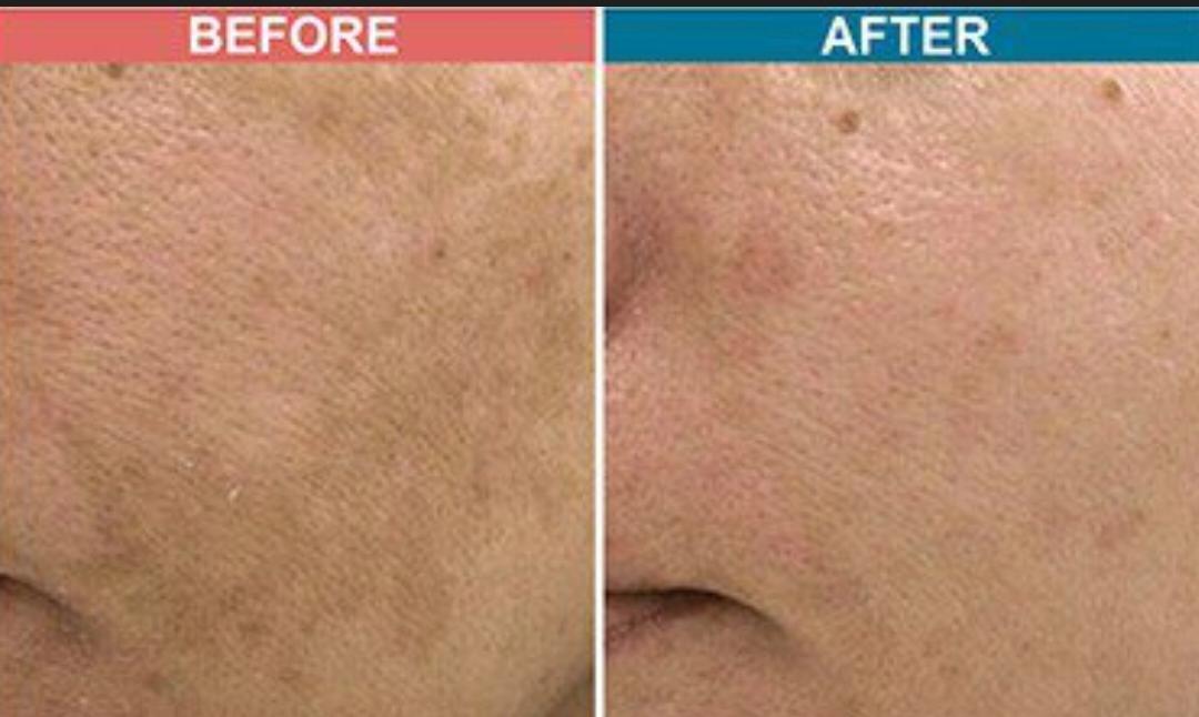 Carbon Laser Facial