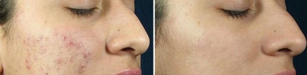 Chemical Peels