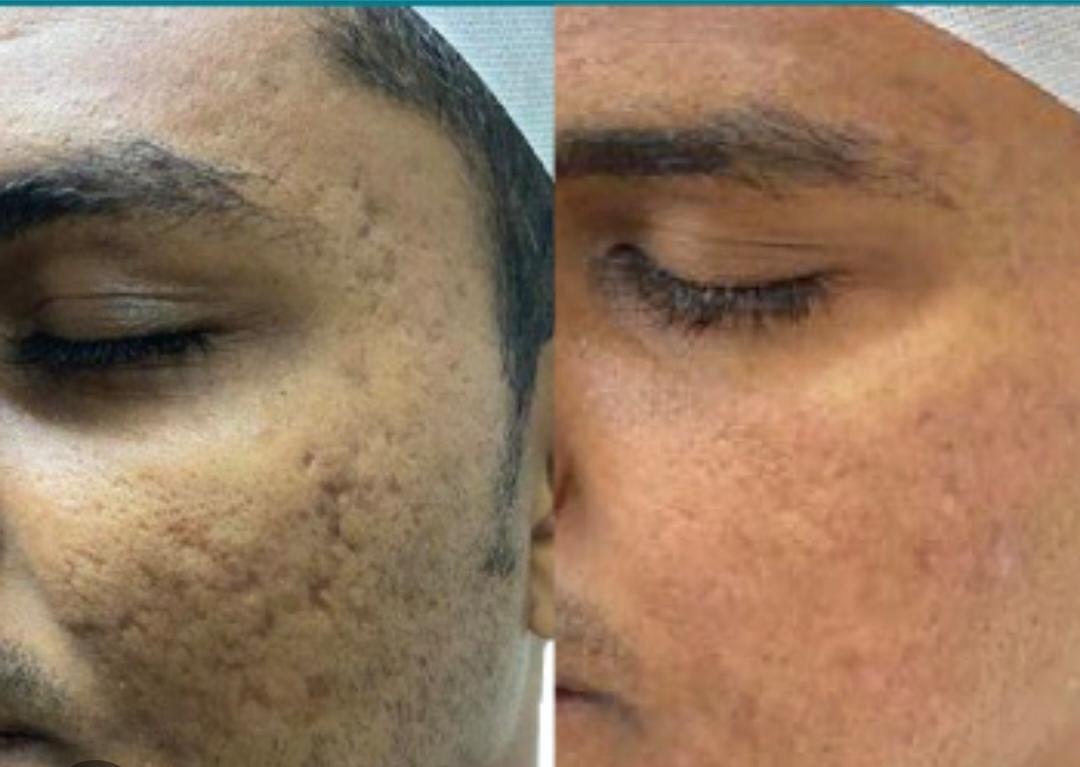Face PRP for Acne Scars