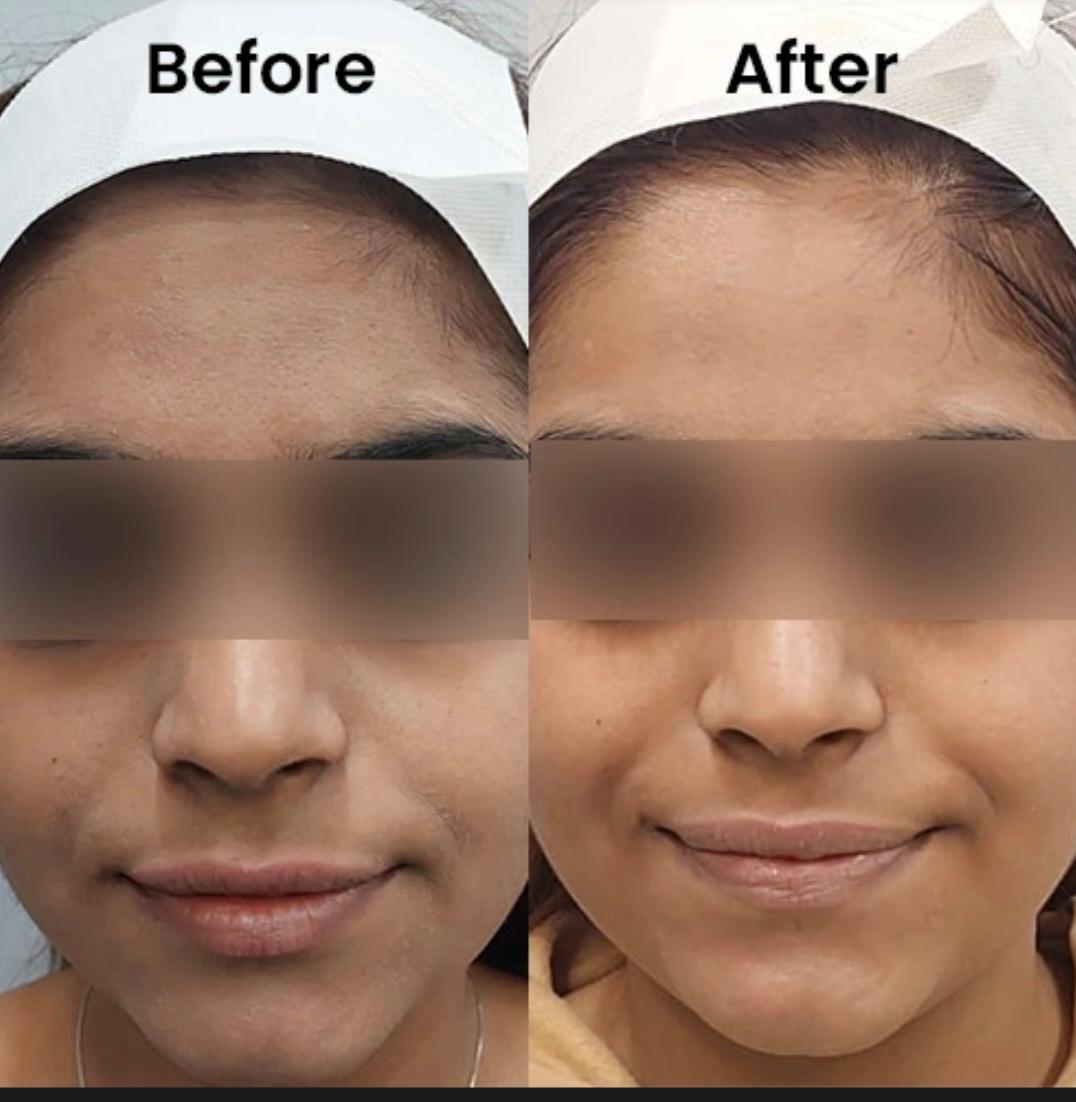 Hydrafacial Treatment
