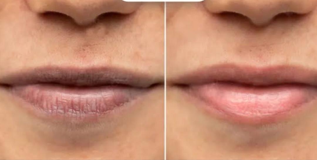 Lip Pigmentation Treatment