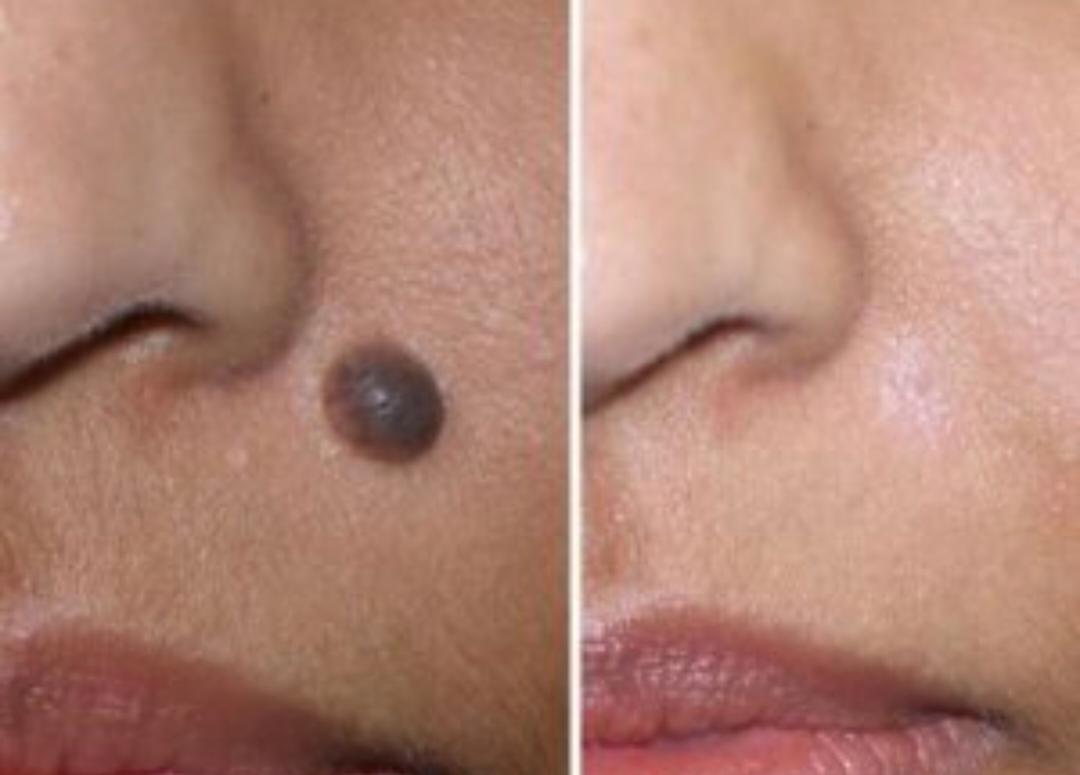 Mole Removal